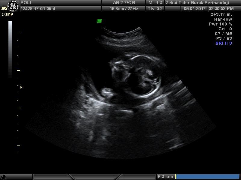 Amnion Sıvı Ultrasonografik Değerlendirilmesi Subjektif ölçüm Maksimum en derin cep Amniotik sıvı indeksi