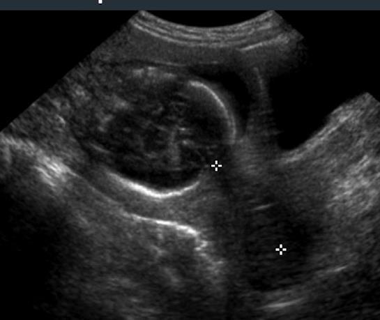 Transabdominal ultrasound Ölçüm kalitesi düşük