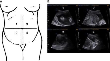 Amniotik sıvı indeksi Prob SDP