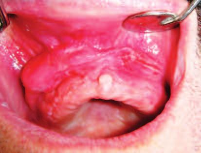 RESİM 1: Nodüler kırmızı-pembe görünümde yaygın klinik olarak epulis fissuratum olarak adlandırılan fokal fibröz hiperplazi.