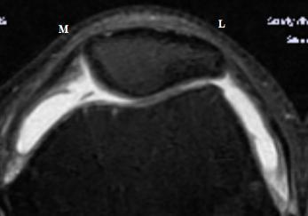 Tip 1 - Medial - lateral faset eşit ve hafif içbükey (Şekil 2.1) Tip 2 - Medial faset laterale göre daha küçük, dış bükeyve düz (Şekil 2.