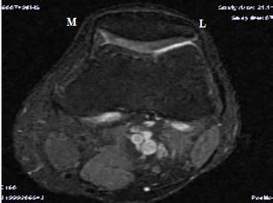 Patellar kondromalazi derecesi değerlendirilmesinde Outerbridge(1961) MRG derecelendirme sistemi uygulandı: Evre 1- Kıkırdakta kontur düzensizliği olmaksızın yumuşama ya da ödem (Şekil 2.