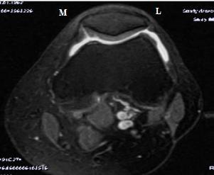 Şekil 2.8.Sağ diz MRG'de evre 3 kondromalazi Şekil 2.9.