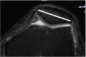 Patella çapları; anterior-posterior, transvers ve kranio - kaudal olacak