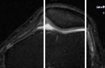 Patella'nın lokalizasyonu femur'un kondillerinden patellahattına doğru