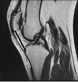 quadriceps femoris tendonunun bitiş yerinden tuberositas