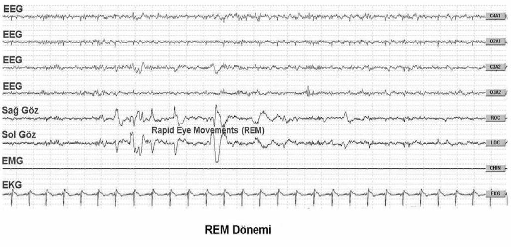 21 Şekil 2.5. PSG (REM Dönemi) Tablo 2.3. Uyku Dönemleri ve Özellikleri Dönem EEG EOG EMG Uyanıklık Göz Kapalı: Ritmik alfa dalgaları (Oksipitalde belirgin).