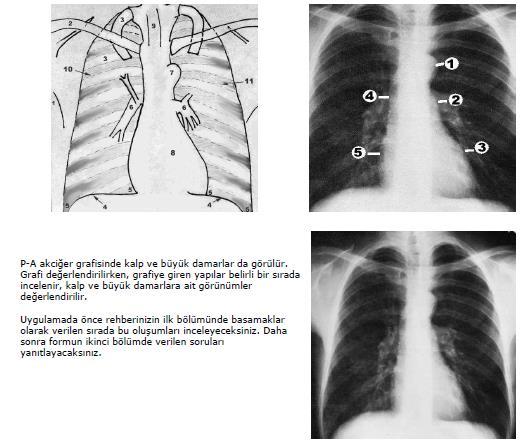 POSTERO-ANTERİOR AKCİĞER GRAFİSİ DEĞERLENDİRME BECERİSİ AÇIKLAMALAR: Postero-anterior (PA) akciğer radyografisi en sık istenilen radyolojik incelemelerden birisidir.