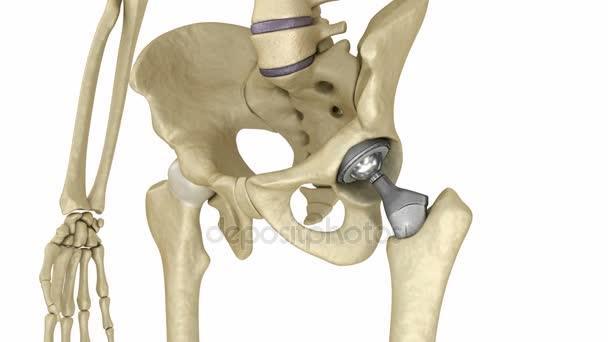 Skolyoz hastasının omurga eğriliği ve tedavi edilmiş hali Ortopedik implantlar Ti ortopedik implantların en yaygın kullanımının mafsal (eklem) sakatlıklarında, özellikle romatizmalı veya dejenere