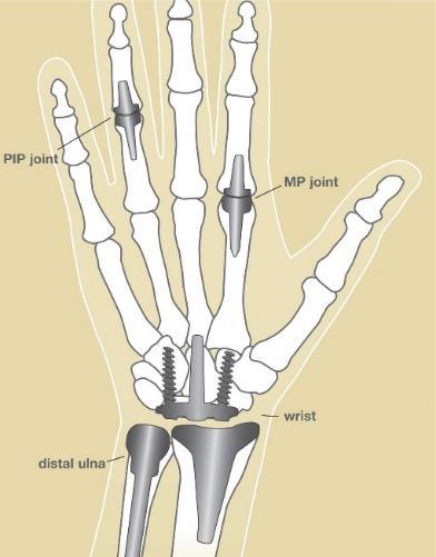 a b Şekil 4. a) Kalça implantı b) El ve parmak eklemi implantları Total diz replasmanı için protezler, femoral, tibial ve/veya patellar komponentlerden oluşur (Şekil 5a) (Li et al., 2014).