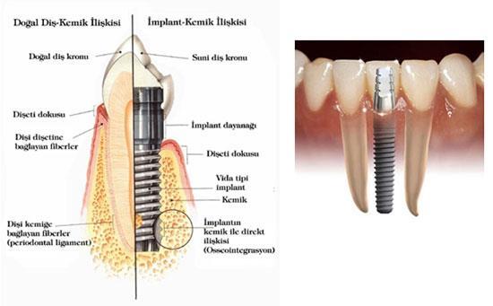 Şekil 6. Titanyum diş implantı uygulaması SONUÇ Gelişmiş ülkelerde, özellikle sağlık sektöründeki teknolojik gelişmelerle birlikte malzeme gruplarının geliştirilmesi hızla artmaktadır.