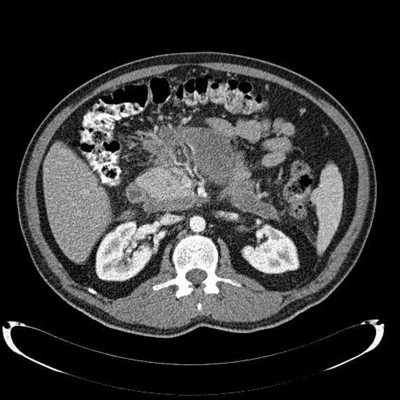 55 year-old man with acute pancreatitis; Axiel contrats enhanced computed tomograhpy shows peripancreatic edema. References: 1. Beckhingam IJ, Bornman PC.