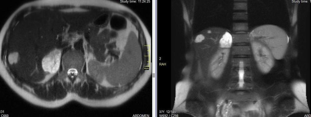 Figure 1: 48-year-old male with left adrenal myelolipoma.