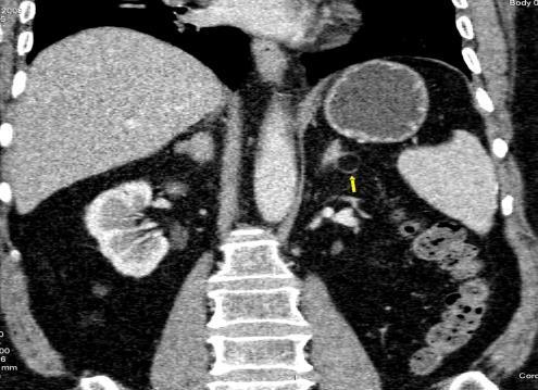 Figure 3: 43-year-old-man, axial non-contrast CT and contrast enhanced CT, the right adrenal gland shows