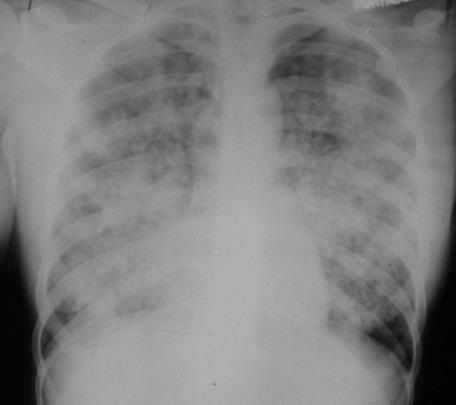 Figre 2: 66-years-old man with acute pancreatit, pulmonary edema in acute respiratory distress syndrome, which can occur as a complication of acute pancreatitis. References: 1.