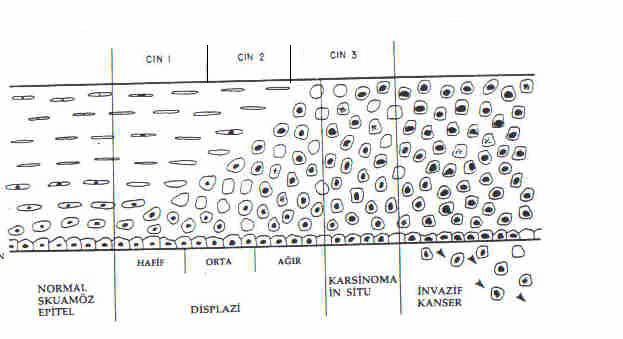 ġekil 3. Servikal intraepitelial neoplazide kullanılan sınıflamaların karģılaģtırılması (17) Ġnvaziv serviks kanserinin ortalama görülme yaģı 45-50 dir.