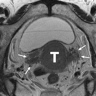 T2- ağırlıklı resimde serviksin ön ve arka dudaklarına yayılmıģ bir tümor
