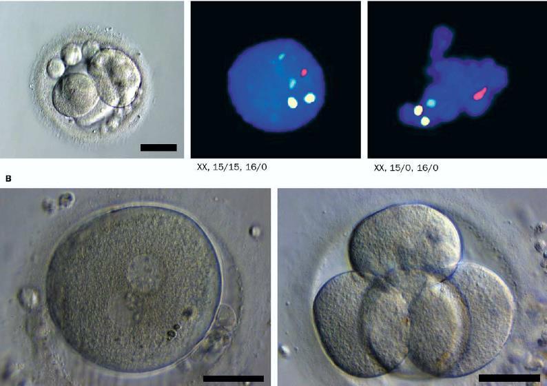 Transplantasyon sonrası ART Heterotopik bölge M1