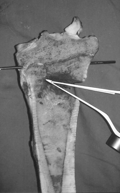 Proksimal Tibia Medial Açık Kama Osteotomisinde Lateral Plato Kırığı Oluşumunu Önlemek İçin Alternatif Uygulama: Dana Tibialarında Deneysel Çalışma medialine, lateral tibia platosunun 1.