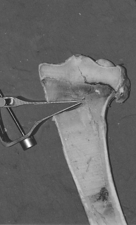 Esenkaya ve ark Osteotominin lateral korteksin 2 cm medialiyle lateral tibia platosunun 3 cm distaline uzanan ve Grup B-2 yi oluşturan tibialara uygulanan distraksiyonlarda ortalama ilk 9.1 ±0.