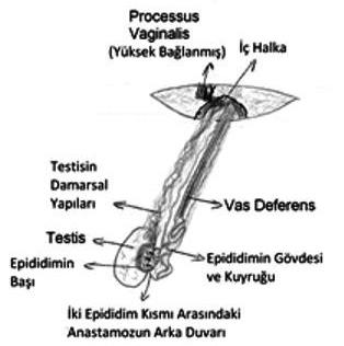 Processus vaginalis yüksek ligasyon için vas deferensden ayrılırken karın içindeki testis iç halkadan dışarı doğdu (Resim 1A,B). Testis normal kıvamda ve normal boyutta (1,5x0.7 cm) idi.
