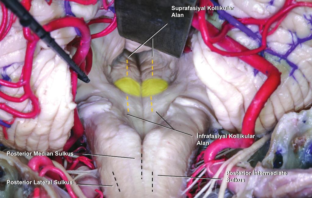Serebellar tonsil çok az retrakte edilerek telovelar kavşağa ulaşılır ve tela koroideanın açılmasıyla 4. ventrikül tabanı ve fasiyal kollikulus çevresine yeterli cerrahi erişim sağlanabilir.