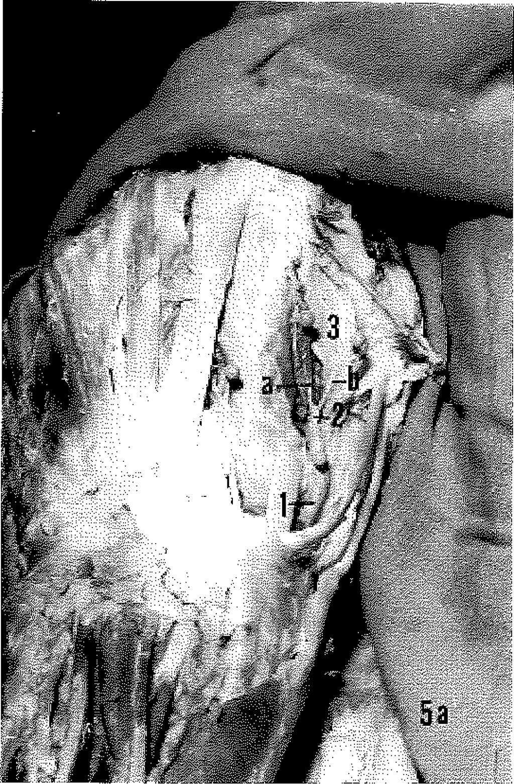 113(4): 265; 1961, 8. Braun, J.B., Werner, JE., Borrelly, J., Foucher, G., Miclıon, J.: Quelques notions d'anatomio arterielle de la main et leurs applications of chirurgicales. Ann. Chir.