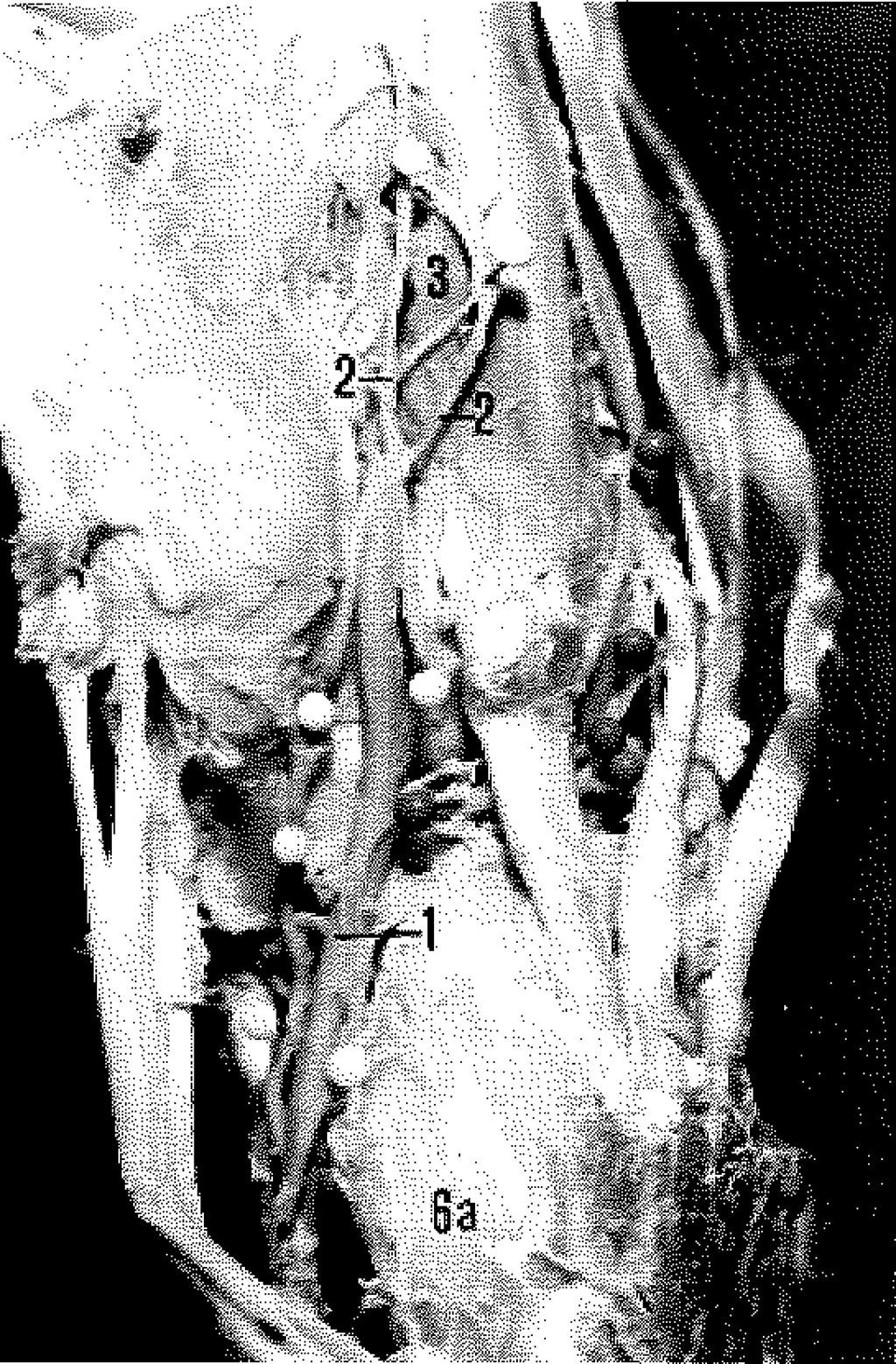 , Rabischong, P., Mansat, M.: Arterial supply of ligaments of metacarpophalangeal joint. J. Hand. Surg. 7: 445, 1982. 11. Bilbo, J.T., Stern, P.H.: The first dorsal interosseous muscle: An anatomical study.