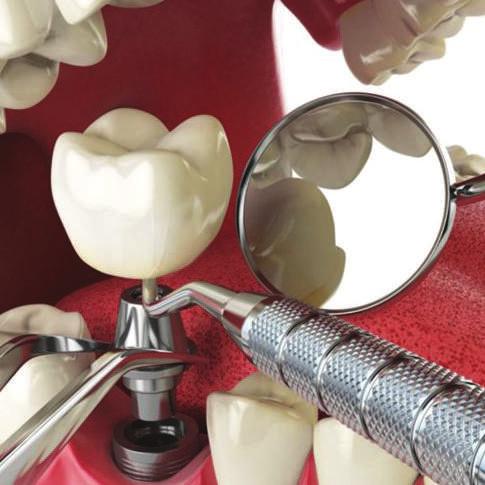 DENTAL İMPLANT CERRAHİSİDENTAL İMPLANT CERRAHİSİ Diş eksiklikleri, çene eklemine iki taraflı olarak dengesiz kuvvet iletildiğinden, daha ileri dönemlerde eklem problemlerine yol açabilmekte ve