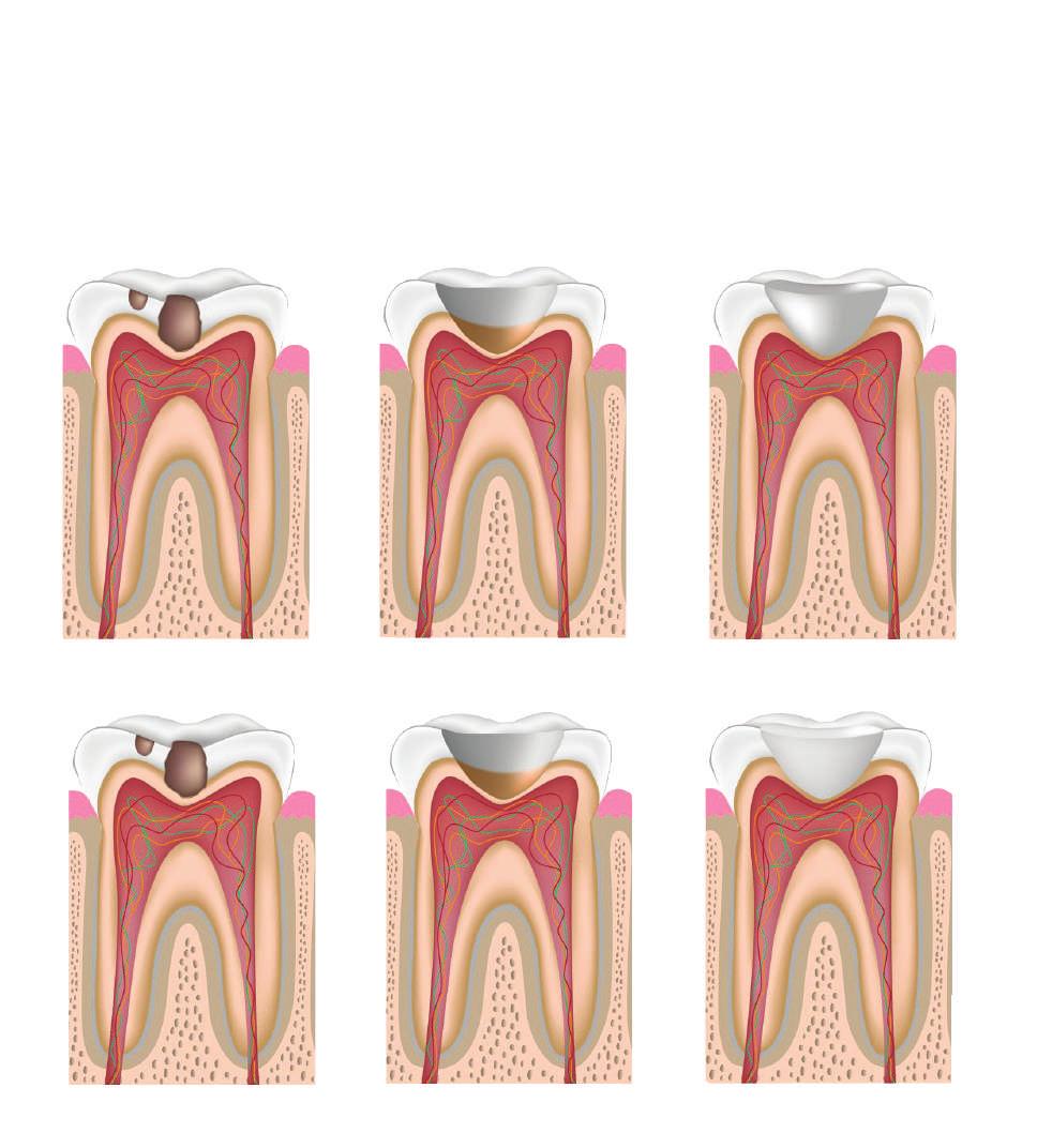 DİŞ DOLGULARI Çürük nedeni ile madde kaybına uğramış dişlerin, çürük temizlendikten sonra çeşitli materyaller ile doldurularak, dişin işlevlerini yerine getirmesini sağlamak amacı ile yapılan