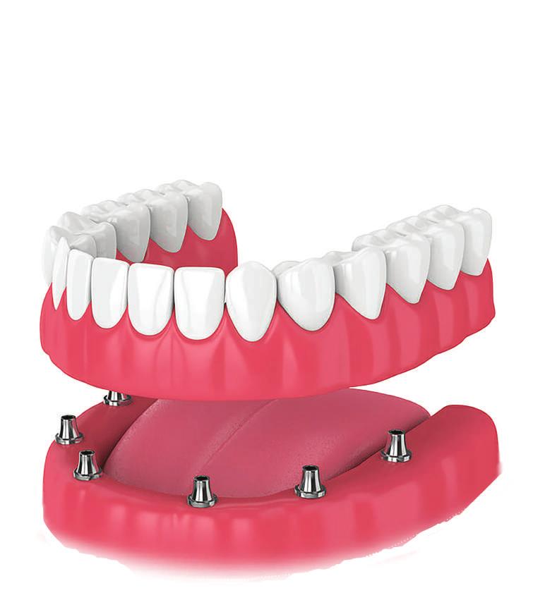 SABİT PROTEZLER Diş çürüğü ve kırığı gibi ileri derecede madde kaybı olan dişler ve şekil, boyut ve renk sorunu olan dişlerden başka, herhangi bir nedenle diş veya dişlerin kaybında yapılan, hasta