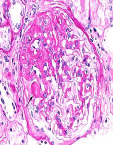 Fokal Segmental Glomeruloskleroz Primer olarak glomerüler visseral epitelyal hücreleri hedef alan bir glomerüler hasar paternidir.