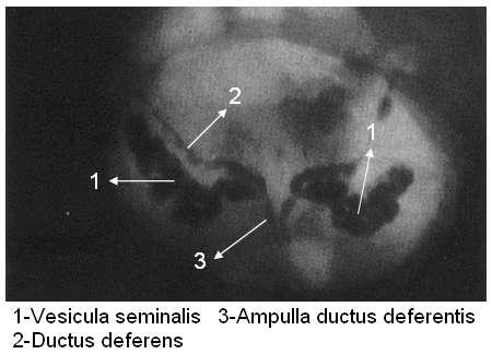 Vezikülografide Anatomik Yapı Seminal