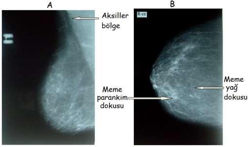 Mamografi A) Mediolateral-oblik,