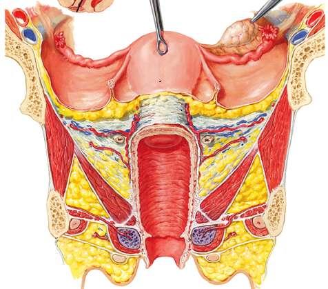 Histerosalpingografide anatomik yapıyı gösteriniz.