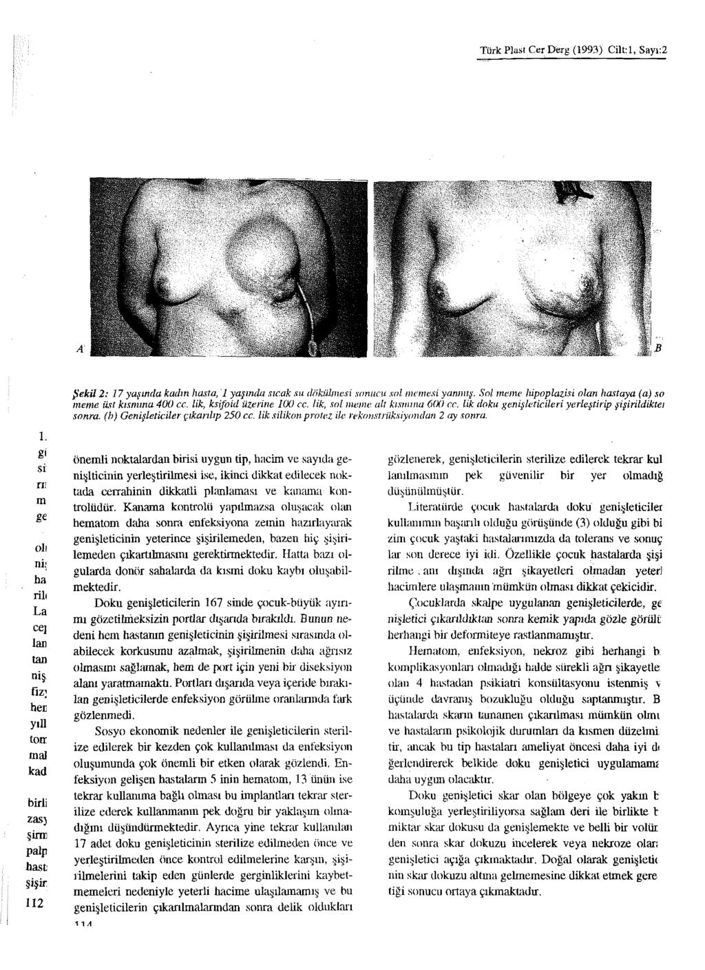 Türk Plast Cer Derg (1993) Ciltrl, Sayı:2 Şekil 2: 17 yaşında kadın hasta, 1 yaşında sıcak su dökülmesi sonucu sol memesi yanmış. Sol meme hipoplazisi olan hastaya (a) s o meme üst kısmına 400 cc.