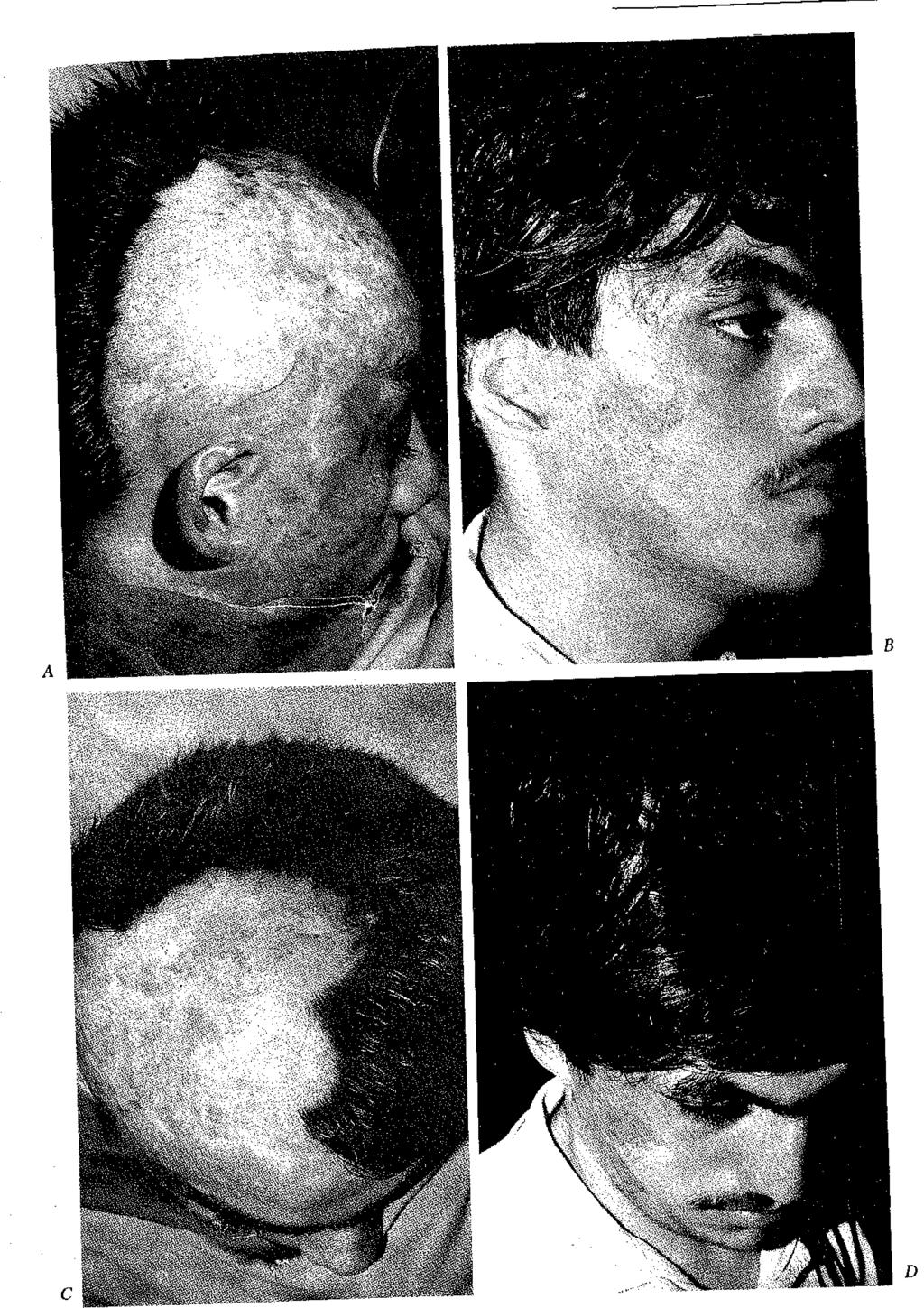 Sağ parieto tempo rai bölgede alopepisi olan hasta ) Ameliyat öncesi sağ yandan görüntüsü, (b) İki kez, ikişer adet 300 cc.