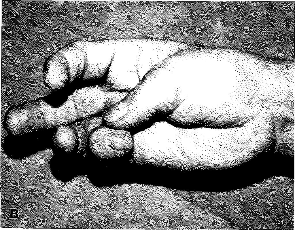 Parmak avulsiyonları birinci parmakta 7 tane, ikinci parmakta 4, üçüncü Olgu sayısı Cilt sütürü Revaskülarizasyon Replantasyon Türk Plast Cer Derg (997) Cilt:5, S.ıyı:!