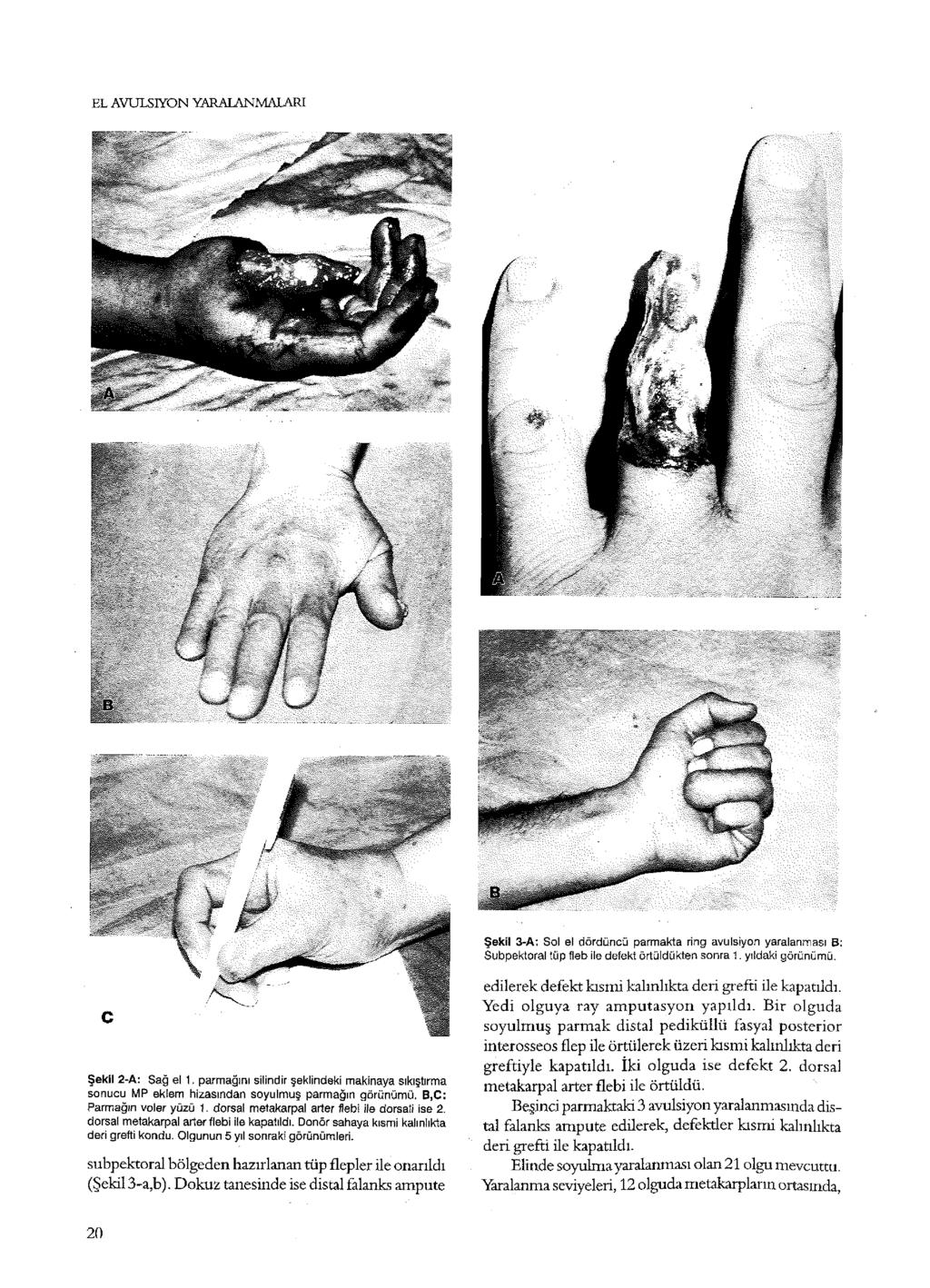 EL AVULSIYON YARALANMALARI Şekil 3-A: Sol el dördüncü parmakta ring avulsiyon yaralanması B: Subpektoral tüp fleb ile defekt örtüldükten sonra. yıldaki görünümü. Şekil 2-A: Sağ el.