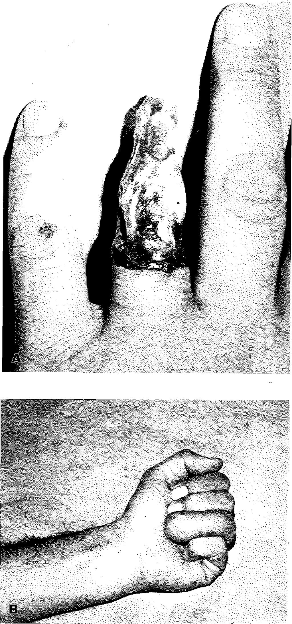 Yedi olguya ray amputasyon yapıldı. Bir olguda soyulmuş parmak distal pediküllü fasyal posterior interosseos flep ile Örtülerek üzeri kısmi kalınlıkta deri greftiyle kapatıldı.