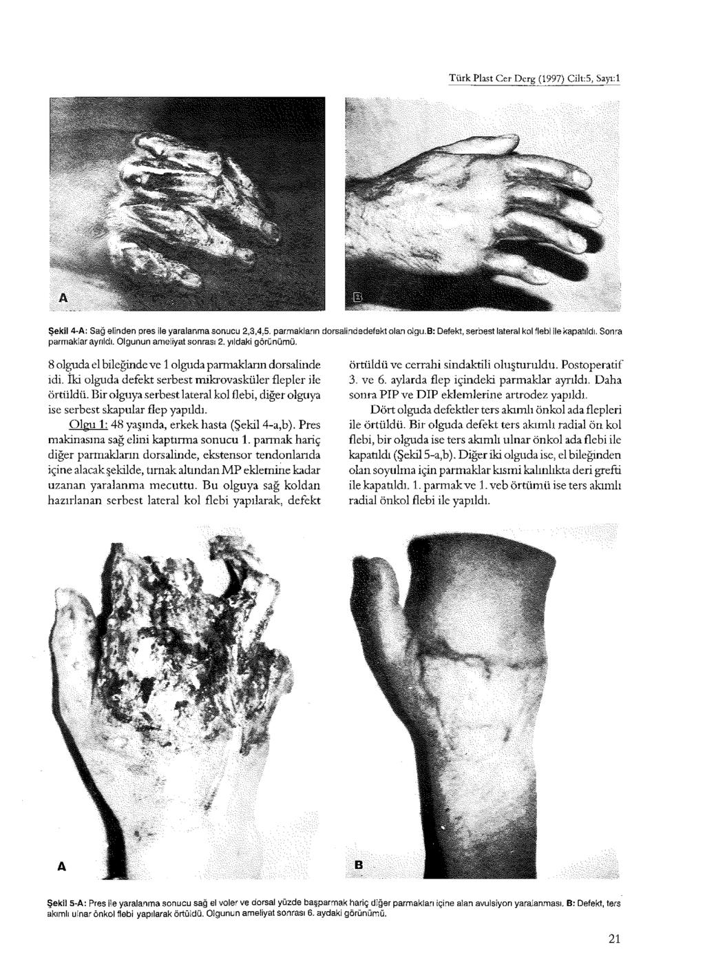 Türk Plast Cer Derg (997) Cîlt:5, Sayı:l Şekil 4-A: Sağ elinden pres ile yaralanma sonucu 2,3,4,5. parmakların dorsalindedefekt olan olgu.b: Defekt, serbest lateral kol flebi İle kapatıldı.