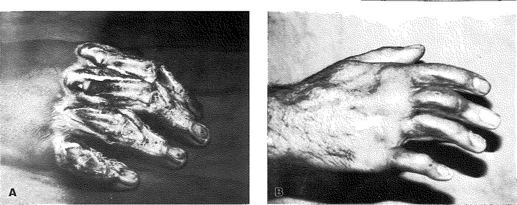 Bir olguya serbest lateral kol flebi, diğer olguya ise serbest skapular fîep yapıldı. Olgu : 48 yaşında, erkek hasta (Şekil 4-a,b). Pres makinasma sağ elini kaptırma sonucu.