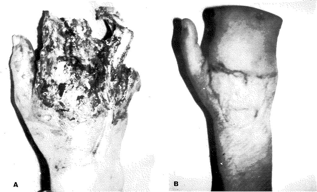 Bu olguya sağ koldan hazırlanan serbest lateral kol flebi yapılarak, defekt örtüldü ve cerrahi sindaktili oluşturuldu. Postoperatif 3. ve 6. aylarda flep içindeki parmaklar ayrıldı.