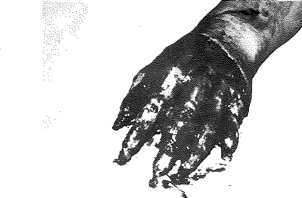 Olgu 5: 26 yaşında, kadın hasta (Şekil 6-a,b). Sol elini silindire kaptırma sonucu, el bileğinden itibaren tüm elinde cilt soyulması mevcuttu. Hastanın 2,3,4,5.