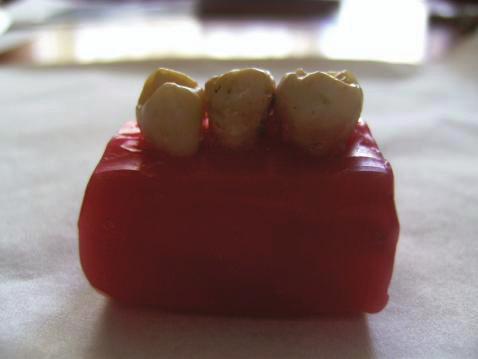 Doğal kontak noktaları oluşturmak üzere diş bloklarının sağ ve soluna yerleştirilen 1 adet premolar ve 1 adet molar dişle beraber, 3 dişin mum bloklara diziliminden oluşan toplam 100 adet diş bloğu
