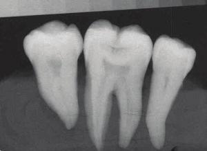 Dentinin orta üçlüsüne kadar uzanan radyolusensi (4).
