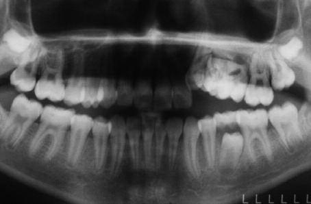 Histopatolojik olarak kompound odontomalar küçük ve tek köklü dişe benzeyerek gevşek fibröz matriks içeren multipl bir yapı gösterir ve mikroskobik kesit hazırlama sırasında diş benzeri yapıların