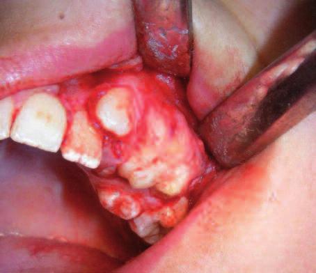 TARTIŞMA Odontomalar, hiçbir belirti göstermeden ve radyolojik değerlendirmeler sırasında tesadüfen tespit edilebilen, oral patolojide sıklıkla