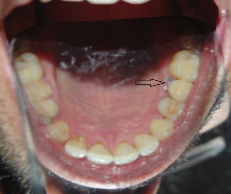 Nadiren dilin dorsal yüzündeki filiform papillanın hiperplazisi koyu siyah pigment birikimi ile birlikte görülebilir.