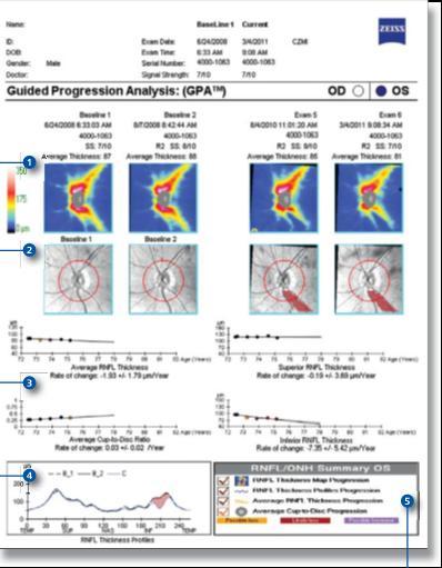 Guided Progression Analysis RSLT Kalınlık Haritası (EVENT ANALİZİ) İki temel ve iki son renk kodlu test RSLT Kalınlık Değişim Haritası Noktasal olarak RSLT değişimi RSLT Kalınlık (Ort, Üst, Alt, c/d